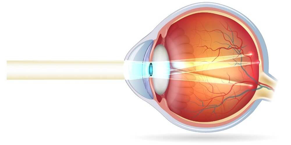 © Tefi/Shutterstock Die schematische Darstellung eines Auges bei Astigmatismus