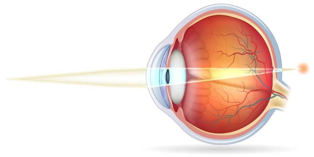© Tefi/Shutterstock Die schematische Darstellung eines weitsichtigen Auges