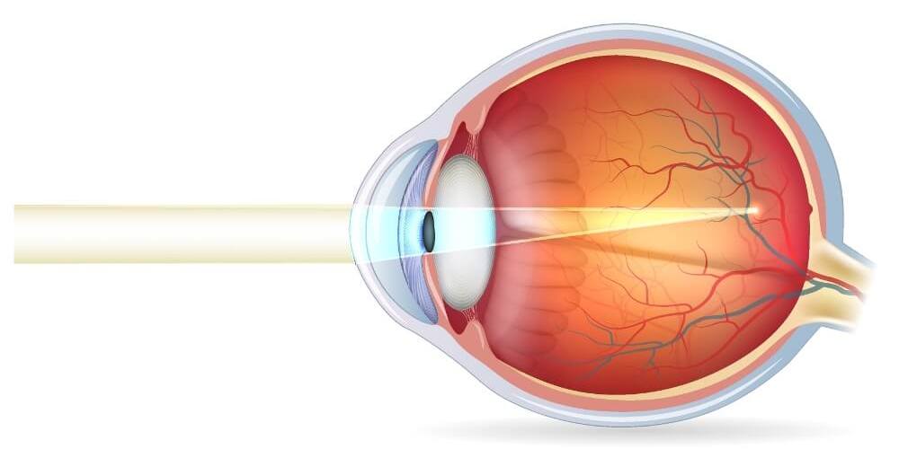 © Tefi/Shutterstock Die schematische Darstellung eines kurzsichtigen Auges